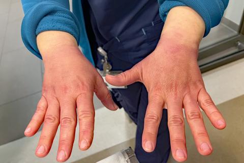Händehygiene-Aktion 2024: Im Fokus die eingeriebenen Hände – die pinke Färbung zeigt an, ob die Händedesinfektion vorher gründlich durchgeführt wurde.